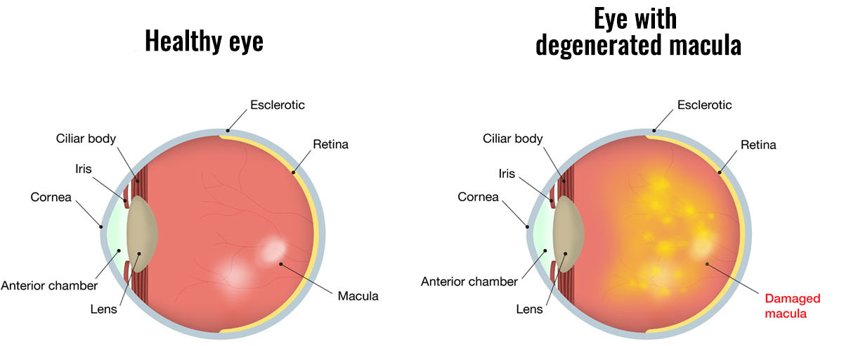 dry vs wet macular degeneration